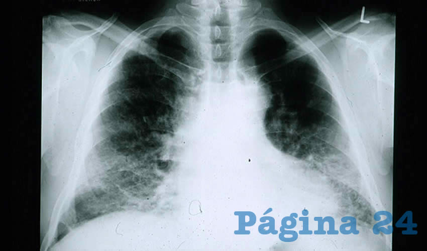 Esta enfermedad se caracteriza por un engrosamiento y rigidez severa de los pulmones, lo que que impide respirar a las personas, siendo esto el principal motivo por el que se desarrolla la insuficiencia respiratoria, un paro respiratorio y eventualmente la muerte/Foto: Cortesía 