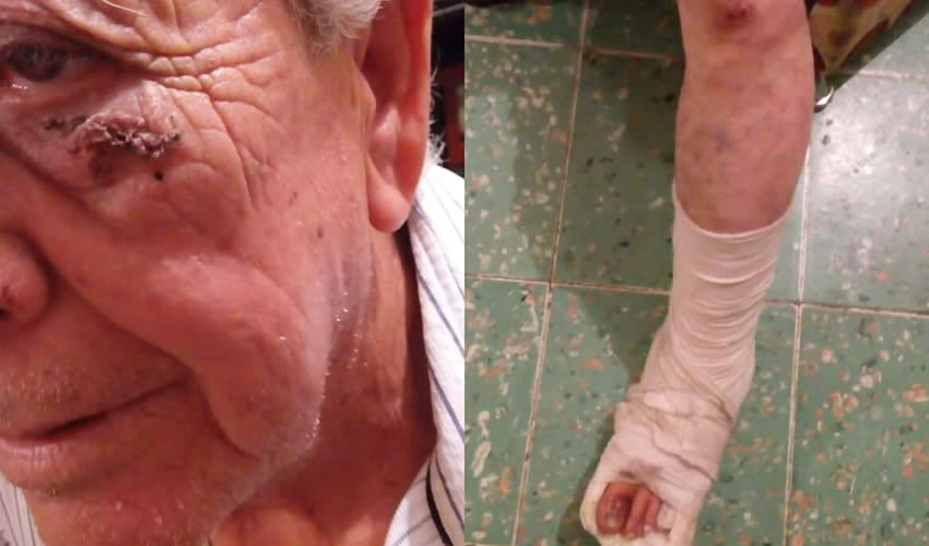 10 días después del accidente que sufrió, en la empresa de transporte público se niegan a indemnizar a Jaime Carvajal Pérez, de 67 años; también la Alianza de Camioneros se niega a atender su problema de salud que podría costarle la pierna/Fotos: Rafael Hernández Guízar 