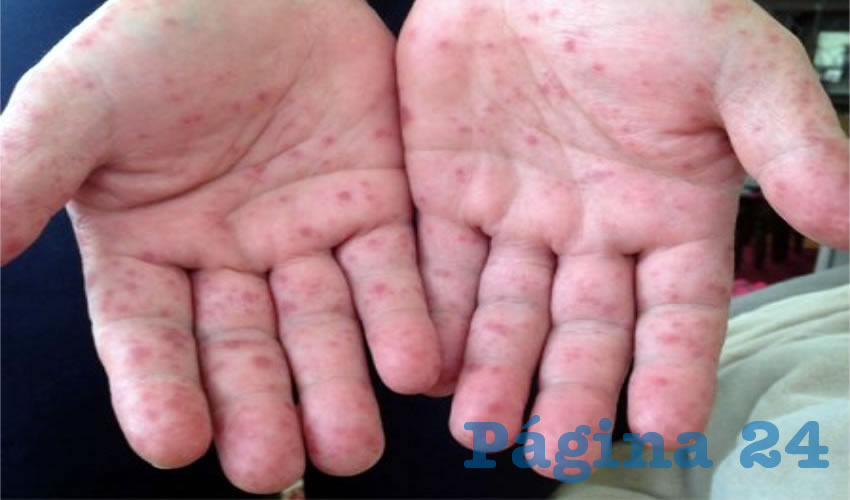 El virus Coxsackie deriva en una enfermedad que, bien atendida, dura de cinco a ocho días sin dejar secuelas