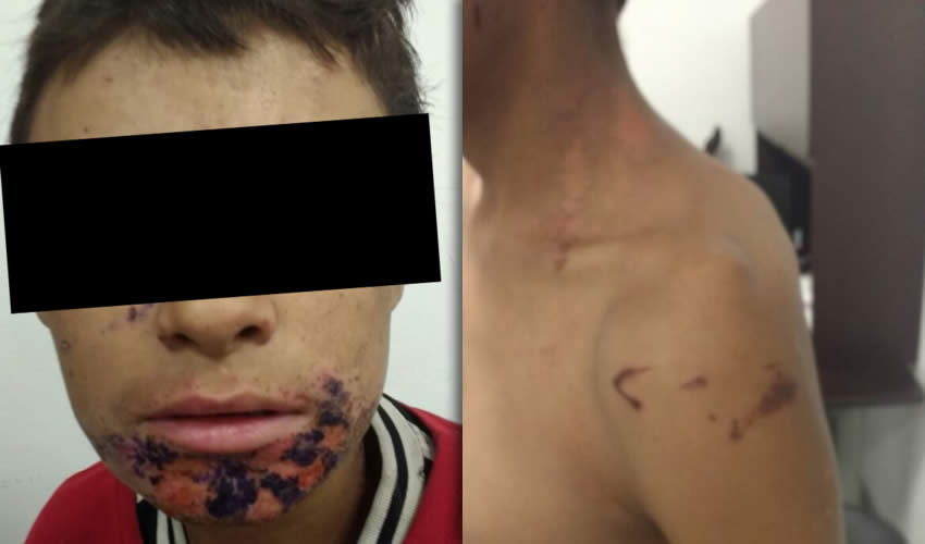 El adolescente muestra las heridas que le produjeron sus captores, algunas de ellas con ácido muriático