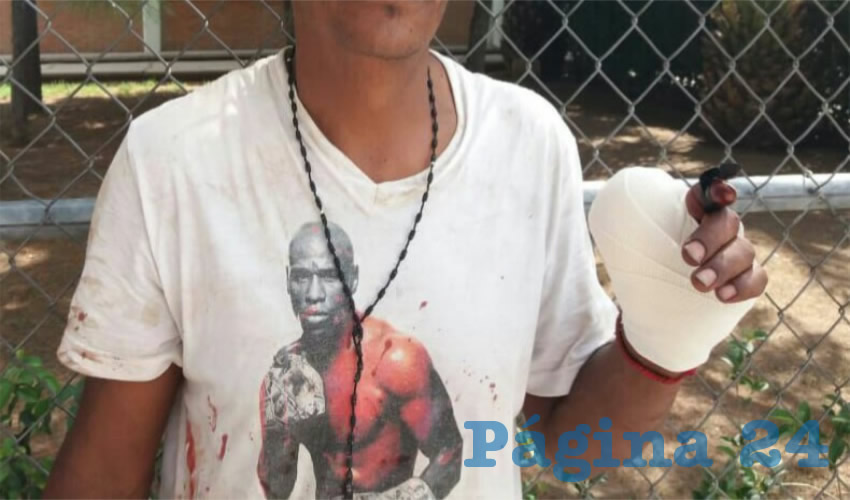Alejandro perdió parte del pulgar izquierdo
