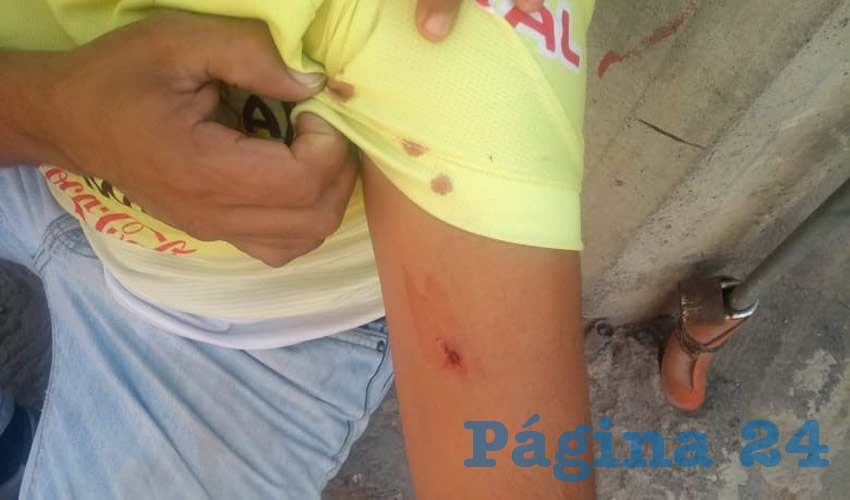La herida con picahielo sufrida por un sujeto